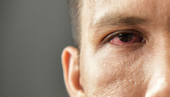 How Do You Get Pink Eye