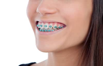 How Much to Do Braces Cost?