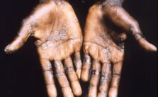 How Contagious is Monkeypox