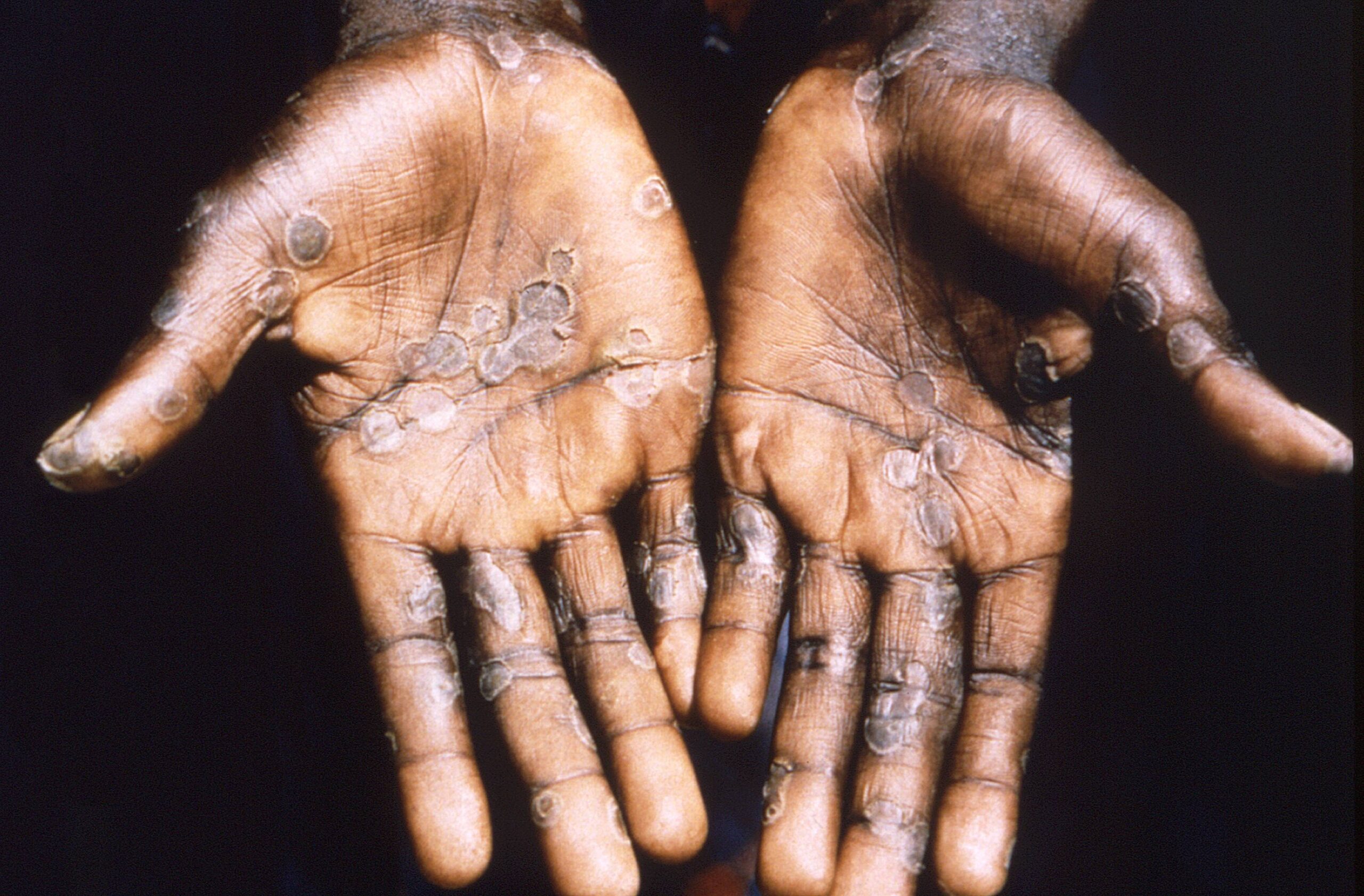 How Contagious is Monkeypox